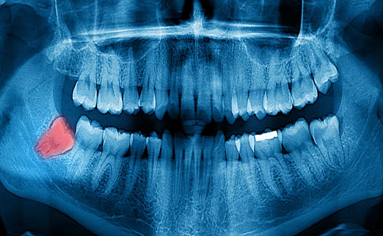 Les dents de sagesse à quoi serventelles et pourquoi sontelles — free download